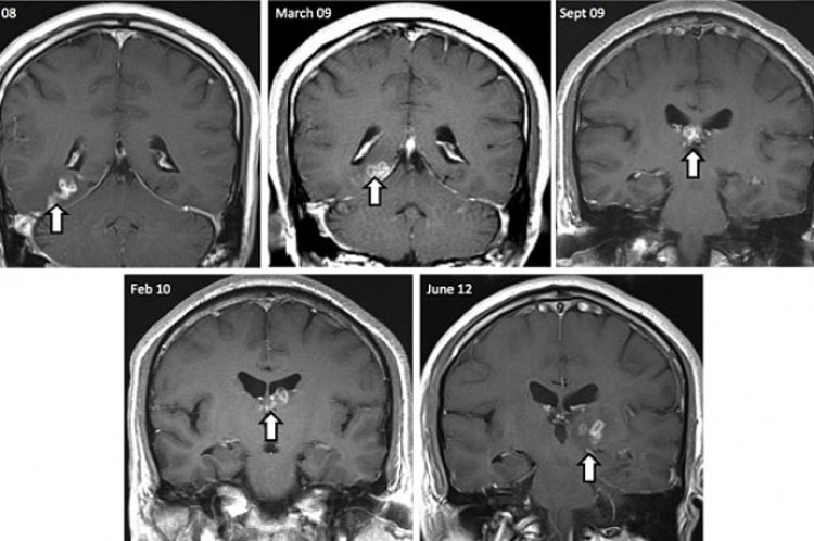 El hombre que tenía un gusano en el cerebro